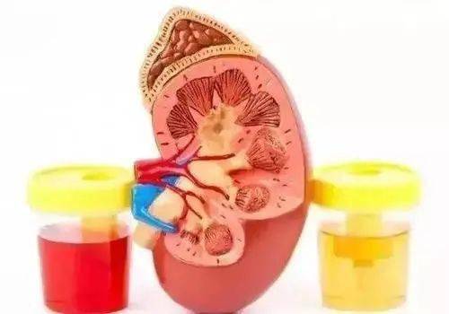 病变|“Alport综合症”是咋回事