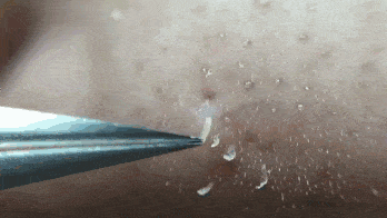 鼻子|米粒大的黑头，瞬间吸出，整个鼻子新生了！