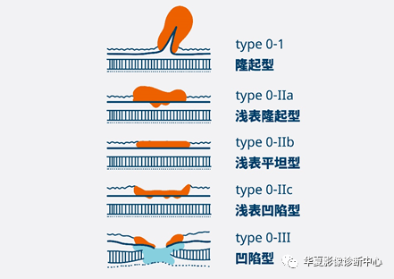 【温故知新】胃癌的分型与分期