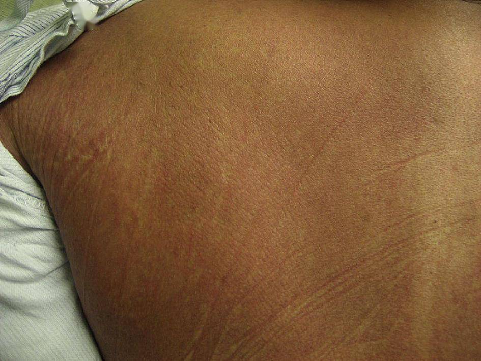 抗结核|抗结核药物的皮肤不良反应