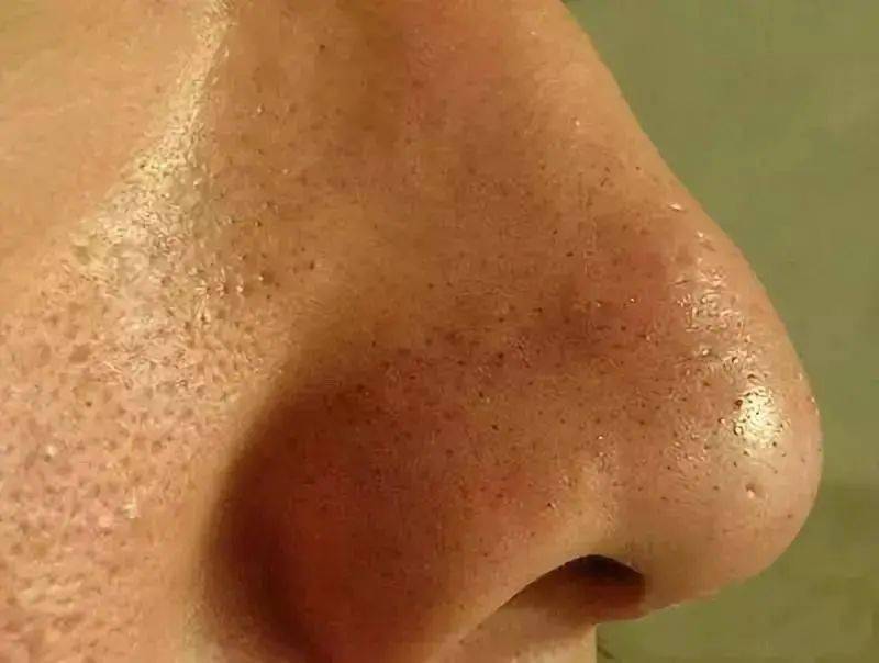 张天|长期闭口、粉刺、痘痘满脸的人，微镜头下毛孔竟然是这样的！赶紧get林允、张天爱的0毛孔秘籍吧！