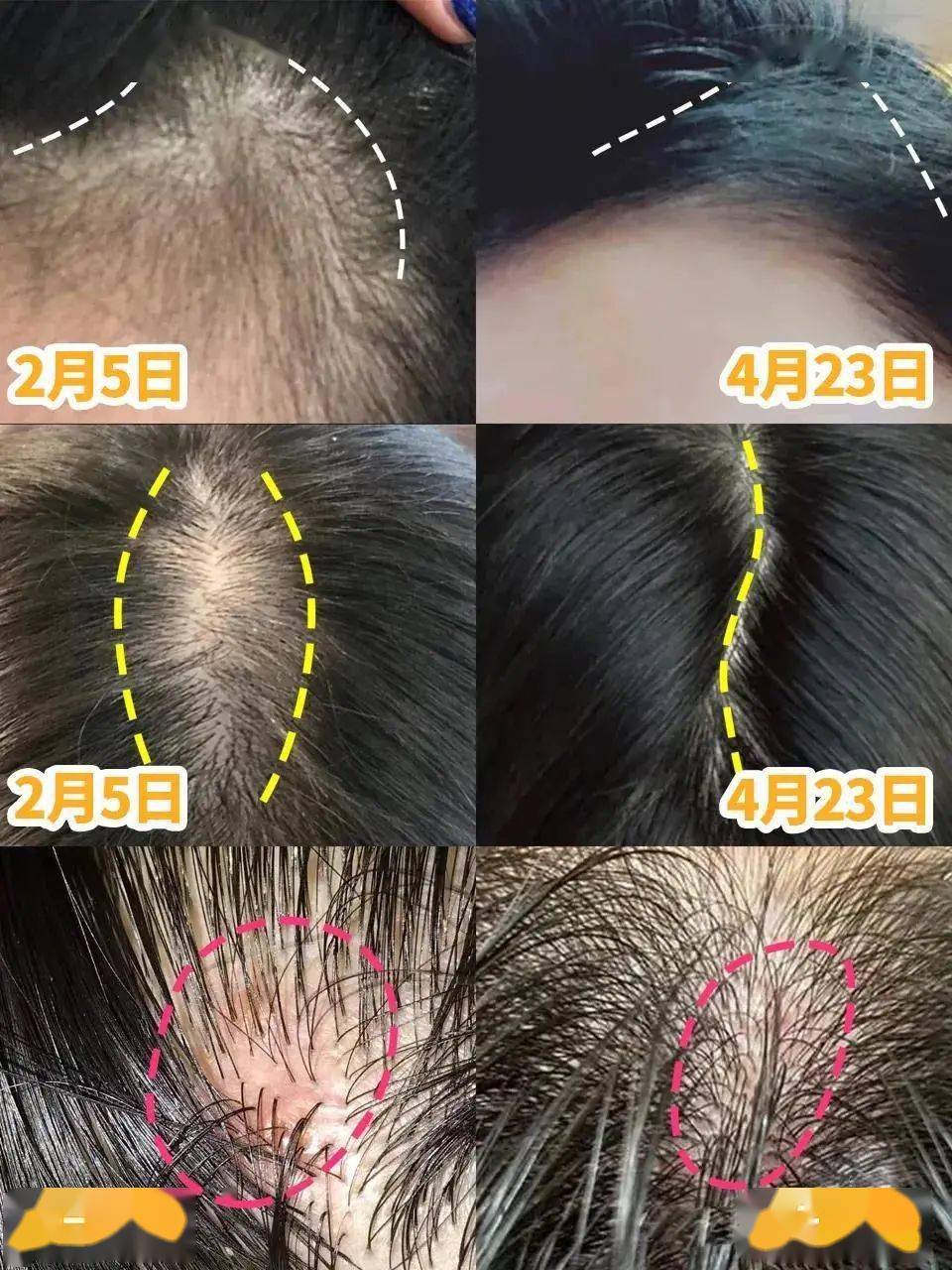 索芙特|超强国货生发!1个月发际线被填满,半年发量暴增!