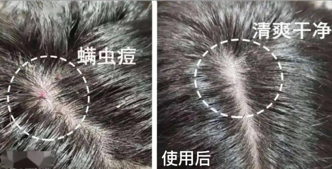 索芙特|超强国货生发!1个月发际线被填满,半年发量暴增!