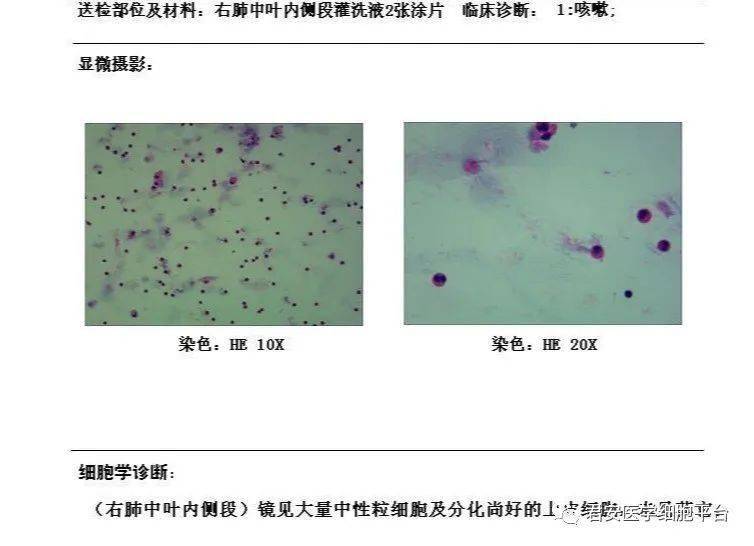 一例肺泡灌洗液嗜酸性粒细胞明显增高病例