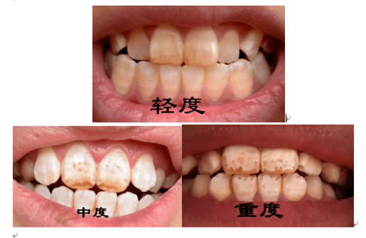 牙齿是人体对氟化物最敏感的器官,如果在牙齿发育阶段,身体长期摄入