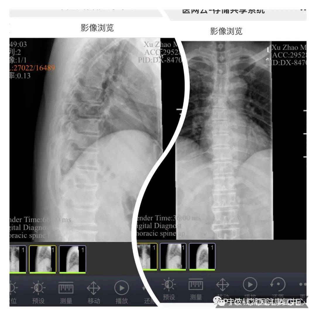 胸腰段椎体边缘唇样质增,椎