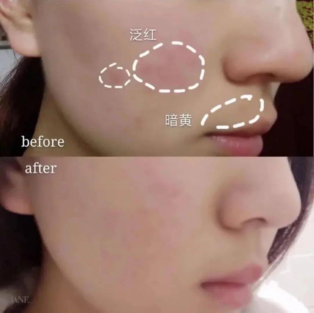 皮肤|刷酸=换脸？这个明星们超爱的百元刷酸好物搞定你的痘痘、闭口、黑头毛孔粗大还不怕烂脸！