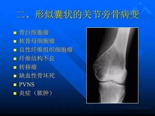 12种关节周围囊状骨破坏的诊断与鉴别_技巧