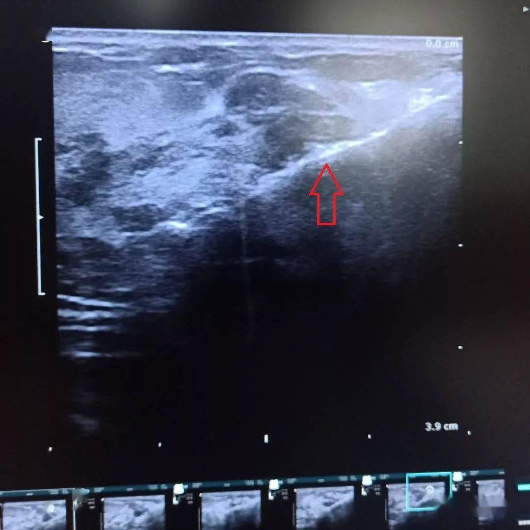 门医技术丨介入强哥系列(1):还在为乳腺结节困扰吗?旋