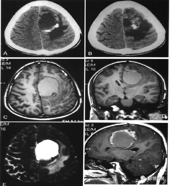 脑实质内囊性病变影像表现_囊虫