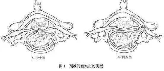 椎间盘突出压迫神经怎么办