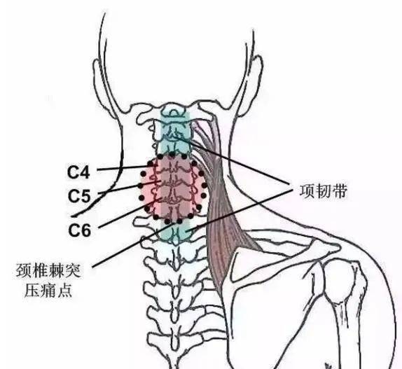 颈椎的压痛点检查