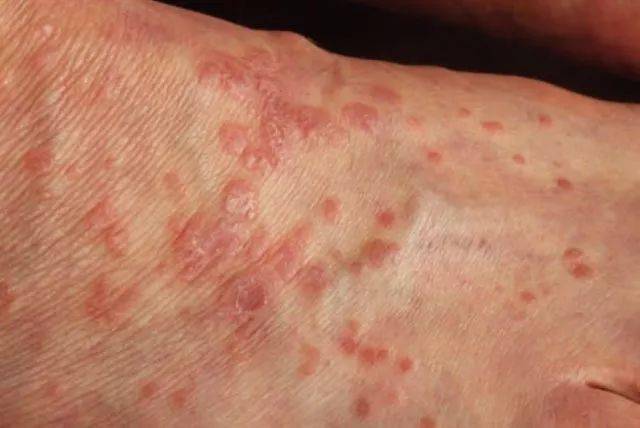 扁平苔癣的典型损害:紫红色多角形扁平丘疹(图片来源:waqner g 等