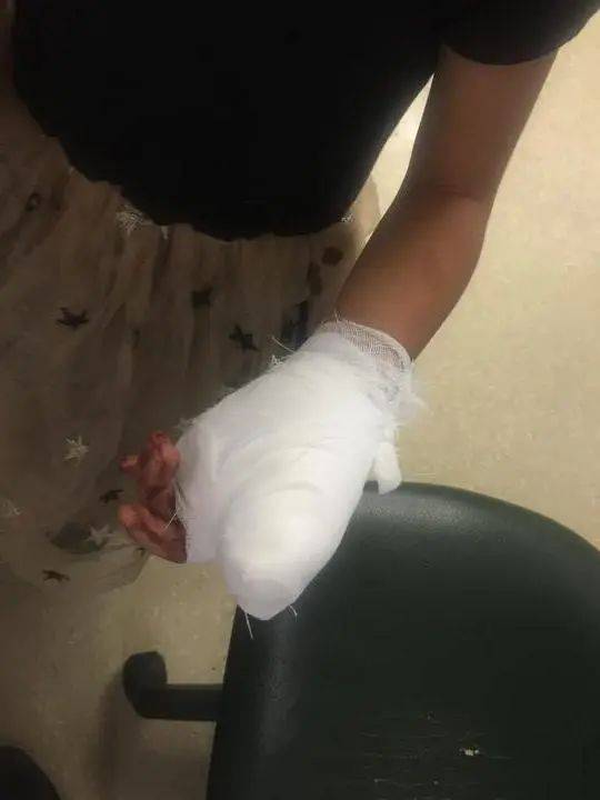 手指|手指保住了5岁女孩拇指被门夹断！妈妈做对这一步