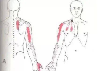 缘上2/3,主要表现的症状为向上传导到肩胛骨脊柱缘上半部及肩胛间区