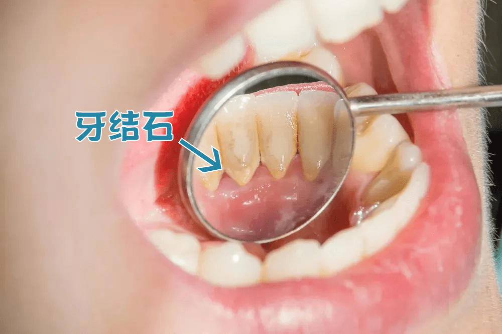 口腔|不到60元的电动牙刷，用起来竟然不输百元大牌！2分钟清洁整个口腔，性价比逆天！