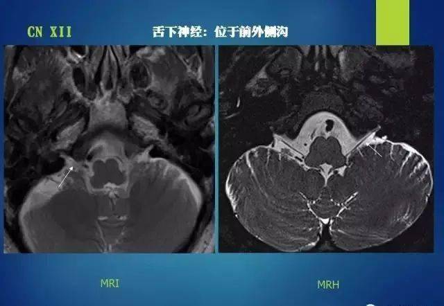 最全的12对颅神经解剖及影像