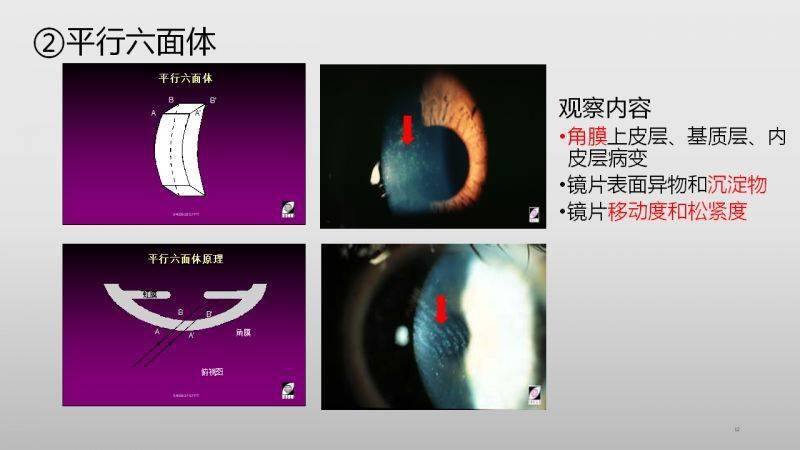 【眼视光】裂隙灯显微镜的使用