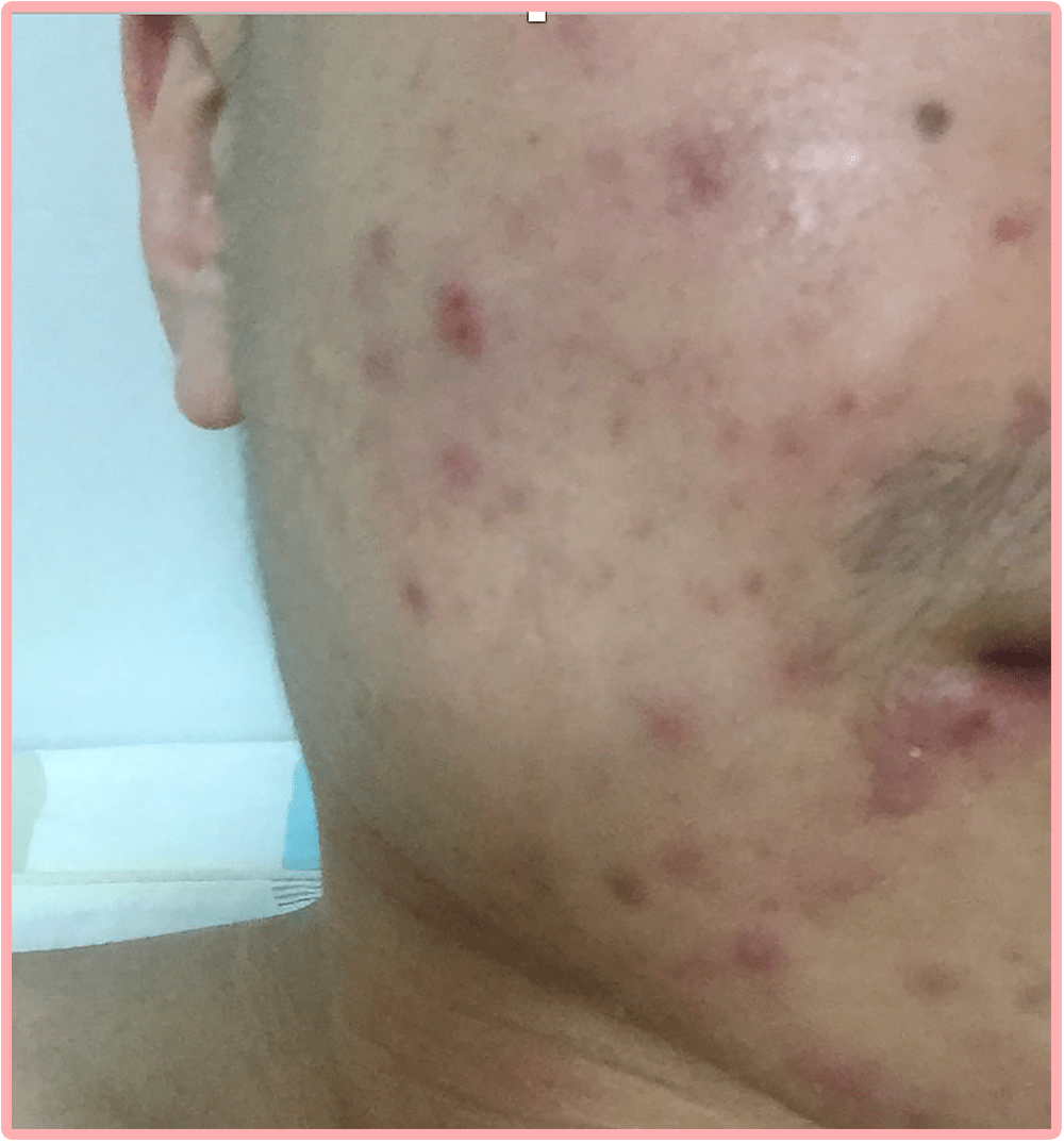 时间|我花3年时间才治好脸，还曾被美容院骗了上万元…