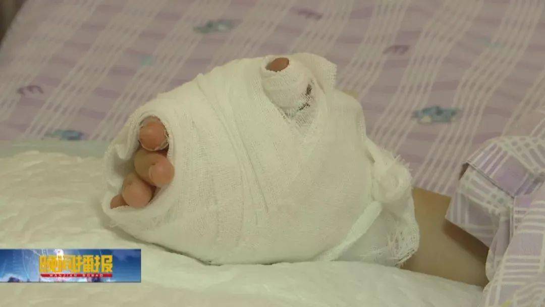 女童|东莞一女童脸部严重烫伤药店滚烫凉茶被撞翻