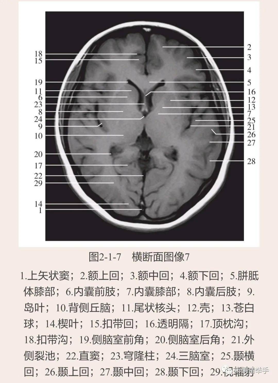 mri矢状位可以直接显示胼胝体形态,是诊断胼胝体发育不全并发颅内畸形