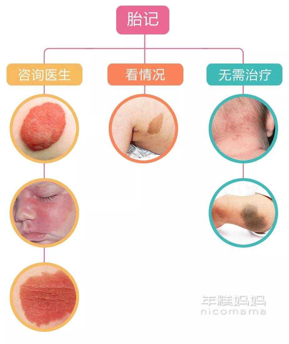 治疗|一定要看！医！生！宝宝的胎记真不用管吗？错！如果长这样