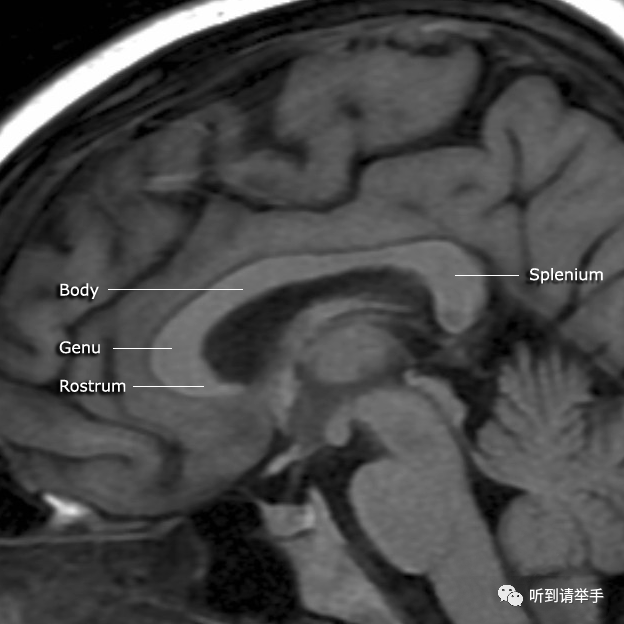 胼胝体影像学上解剖形态上帝这种缺德行为,导致的后果,学名叫做