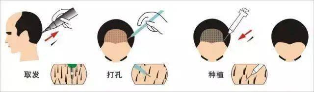 移植|国庆回去，我打算植发了！