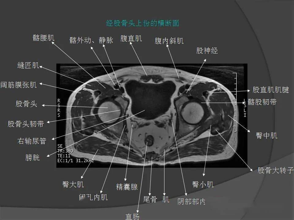 骨盆肌肉mri断层解剖