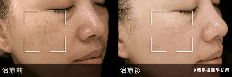 女人|如果你正长“色斑”,试试这个新方法,惊喜到让你尖叫!