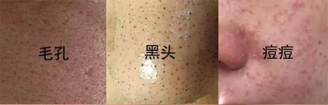 氨基酸|拒绝“螨虫脸”，5秒揉一揉，螨虫全出来了，痘痘黑头全没了！