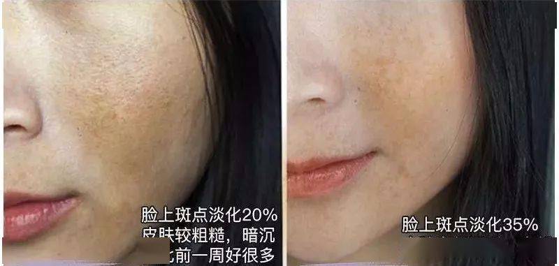 色斑|连抹7天,斑没了,皮肤真的白一度!
