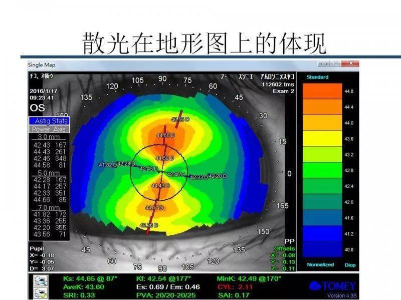 【眼视光】 角膜地形图阅读及基本使用