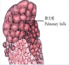 "肺大泡,一个被忽略了的"小问题"_手机搜狐网