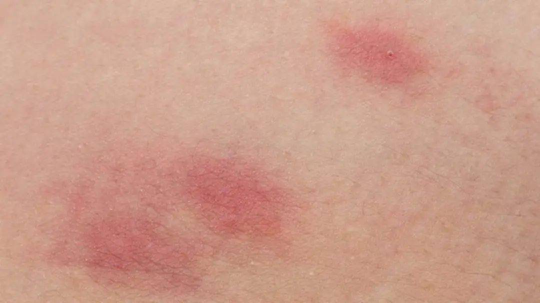 皮疹——或成为第四个常见新冠患病症状