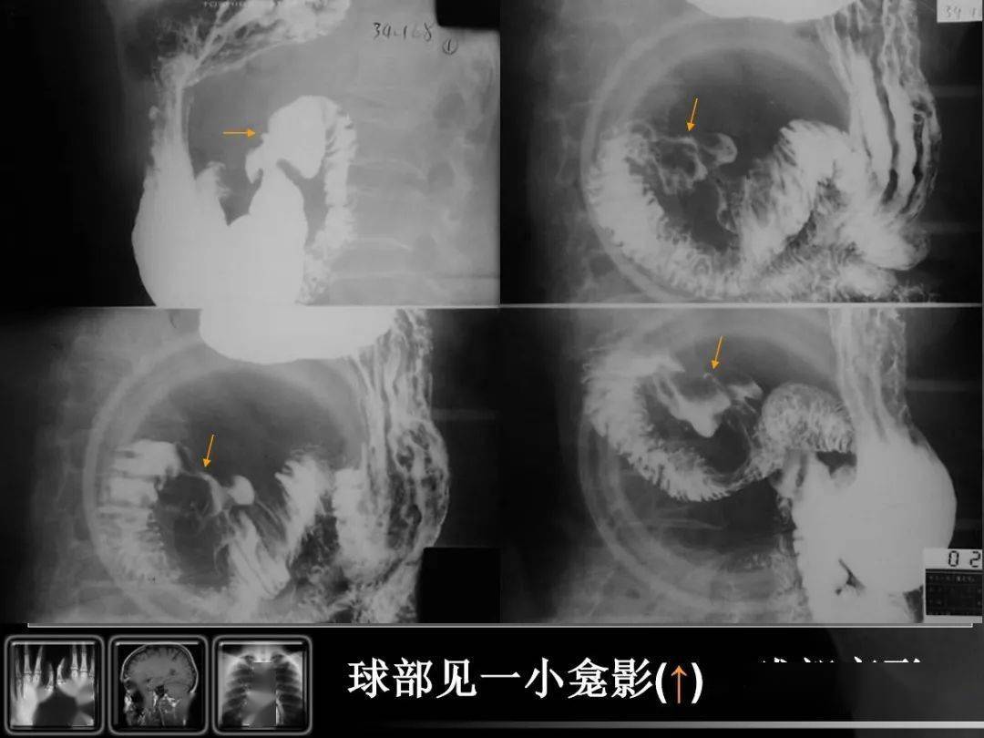 【汇总】消化道疾病影像诊断与鉴别_造影