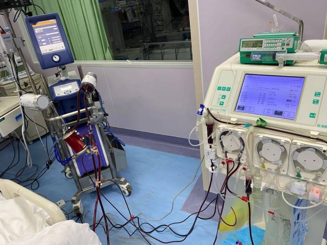 是体外膜肺氧合的简称,缩写为ecmo