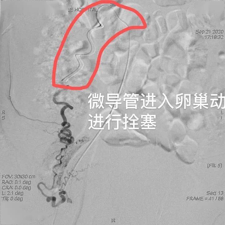 景洪市第一人民医院采用介入手术成功救治罕见产后卵巢动脉破裂患者