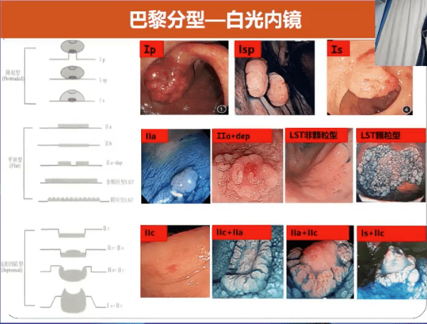 如何快速识别早期结直肠癌?这2种息肉分型一定要掌握