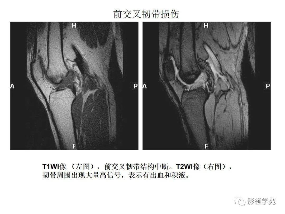 在各序列中均呈低信号,矢状面后交叉韧带为凸面向后的弓形,边缘光滑与