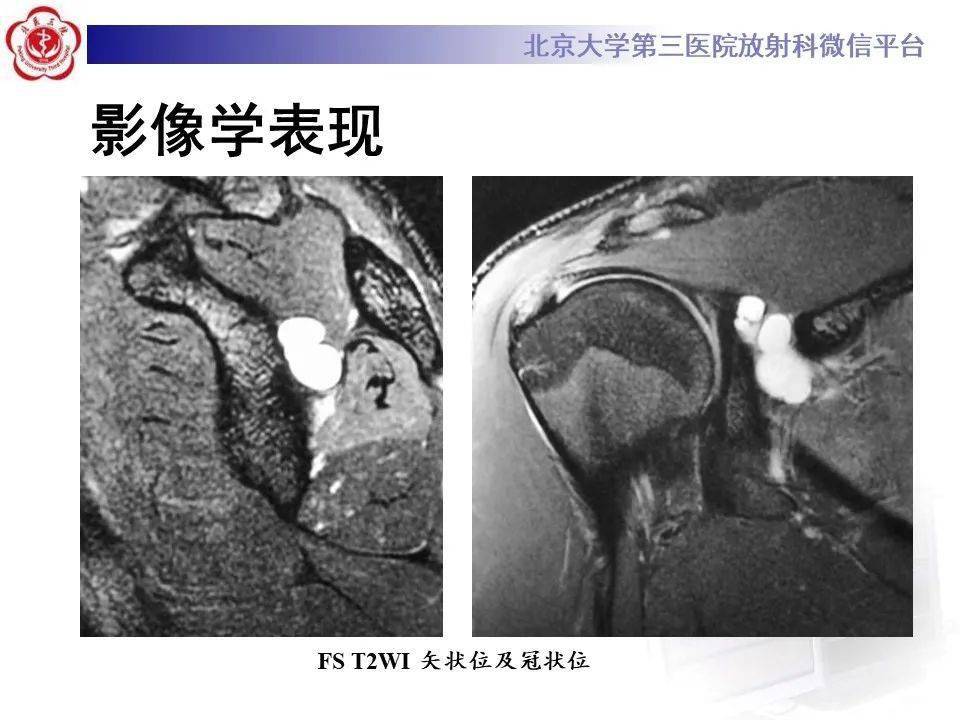 肩胛上神经卡压影像表现