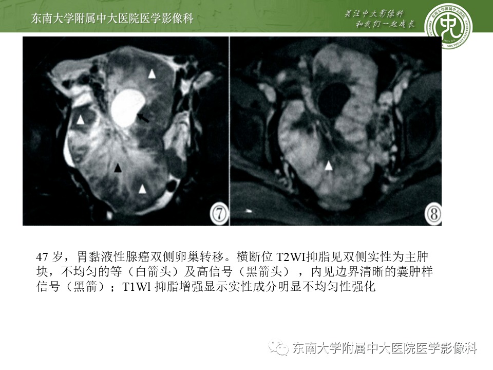 病例结果:卵巢转移瘤(krukenberg瘤)编辑/校对:郑孝飞增强ct女,40岁