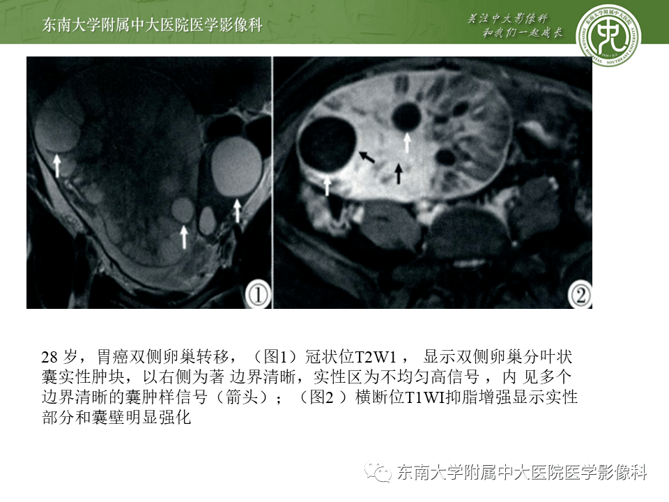 病例结果:卵巢转移瘤(krukenberg瘤)编辑/校对:郑孝飞增强ct女,40岁