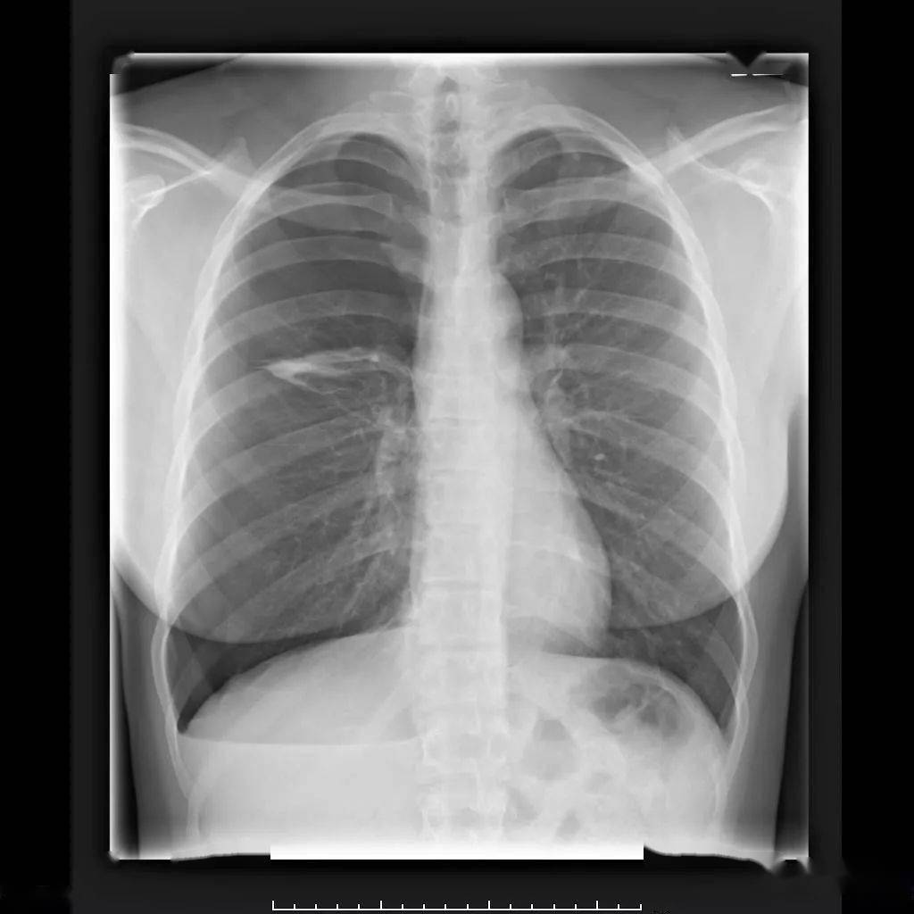 右肺门区高密度影可能代表肺不张或者瘢痕纤维化.左肺未见明显异常.