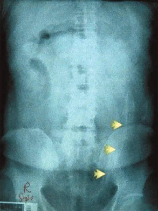 塞2斤金条藏8部手机…人类对肛门的探索太可怕了