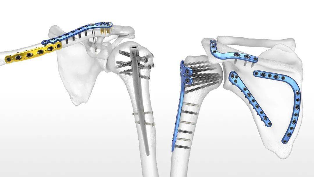 【筋骨论】取还是不取？骨伤科专家为你解密奥妙_钢板