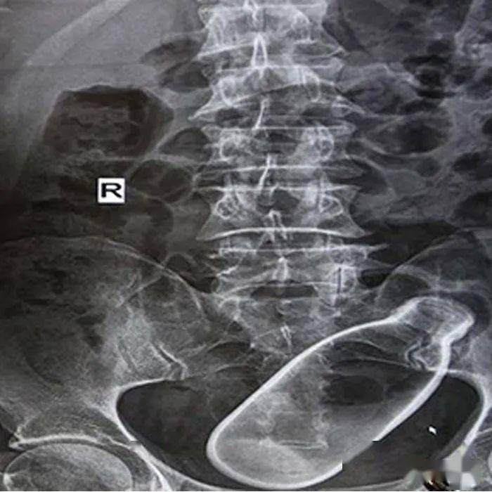 塞2斤金条藏8部手机…人类对肛门的探索太可怕了