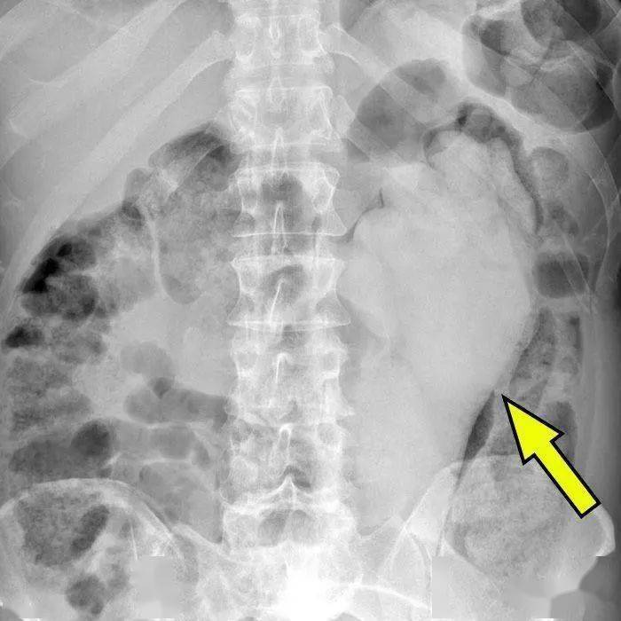 塞2斤金条藏8部手机…人类对肛门的探索太可怕了