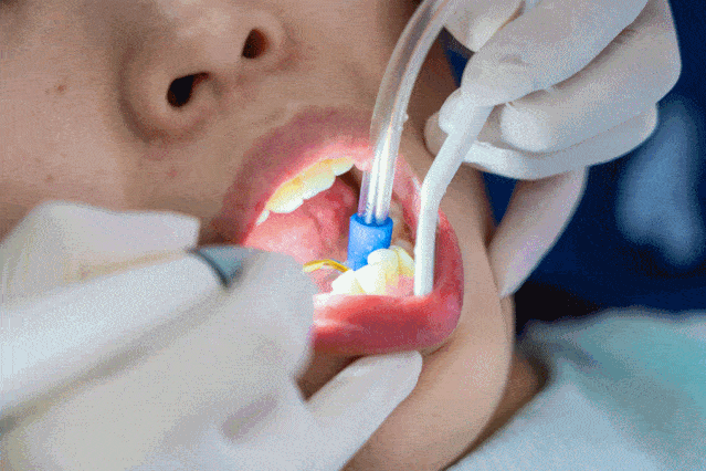 口腔|这波不亏！39.9元抢豪华洗牙套餐，告别“笑容尴尬症”！