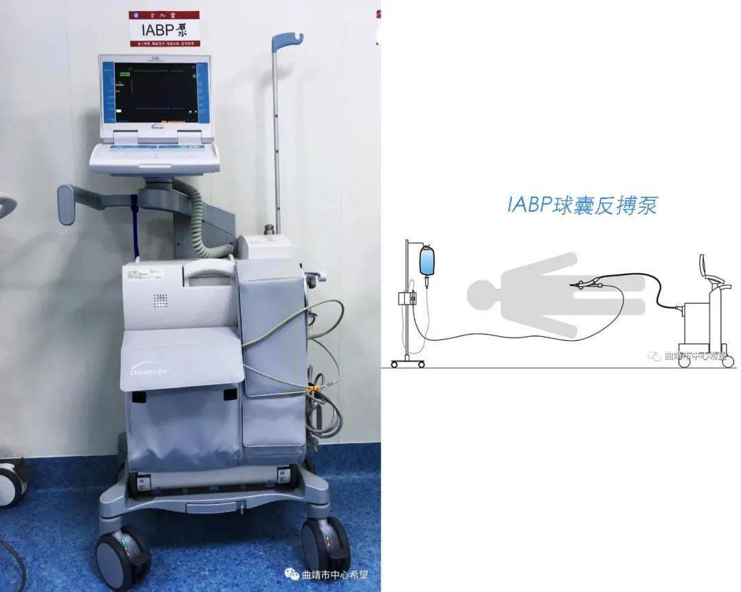 曲中pci解码起死回生cpr室颤除颤同时实施iabp和临时起搏器辅助下的